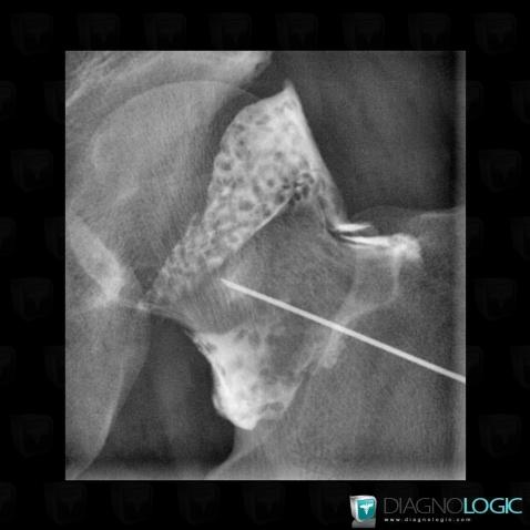 Chondromatose synoviale, Articulation coxo fémorale, Radio