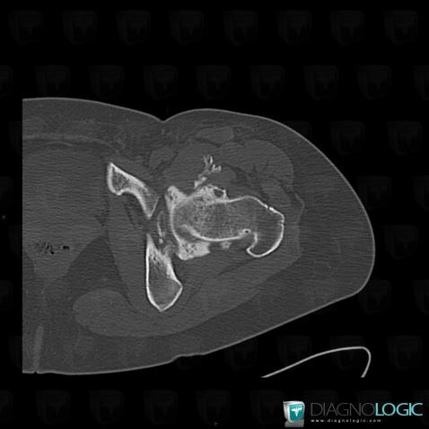 Chondromatose synoviale, Articulation coxo fémorale, Scanner