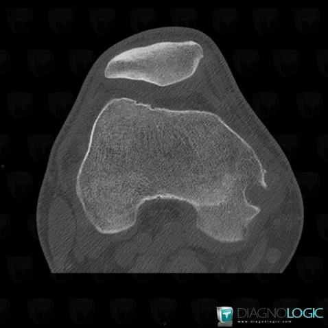 Chondrosarcoma, Femur - Distal part, CT