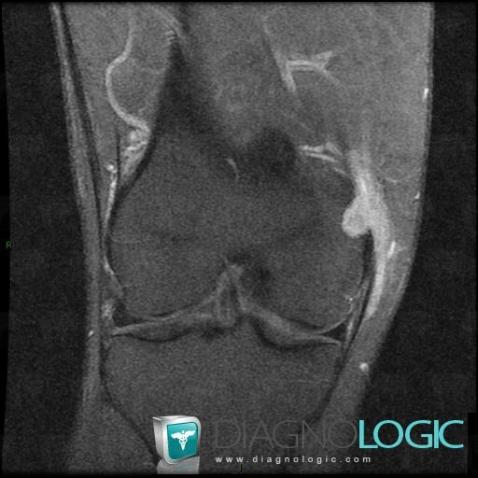 Chondrosarcoma, Femur - Distal part, MRI