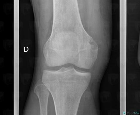 Chondrosarcoma, Femur - Distal part, X rays