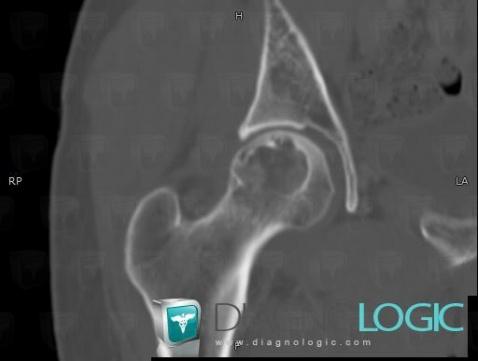 Chondrosarcoma, Femur - Proximal part, CT