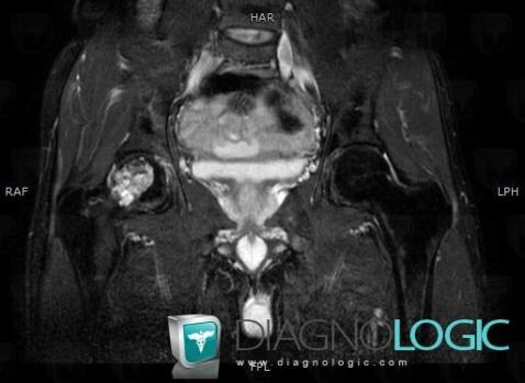 Chondrosarcoma, Femur - Proximal part, MRI