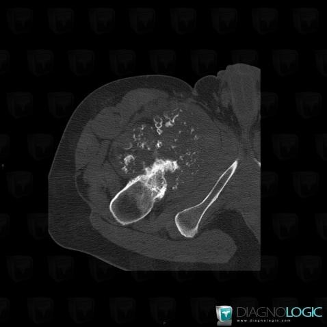 Chondrosarcoma, Femur - Proximal part, Pelvic Muscles, CT