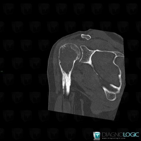 Chondrosarcoma, Humerus - Proximal part, CT