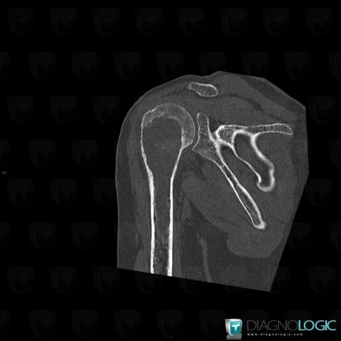 Chondrosarcoma, Humerus - Proximal part, CT