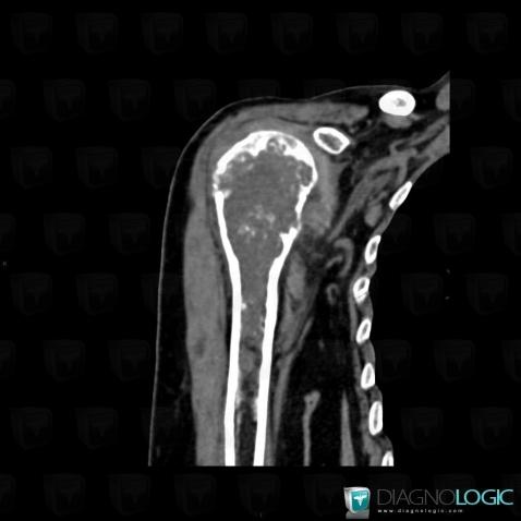 Chondrosarcoma, Humerus - Proximal part, CT