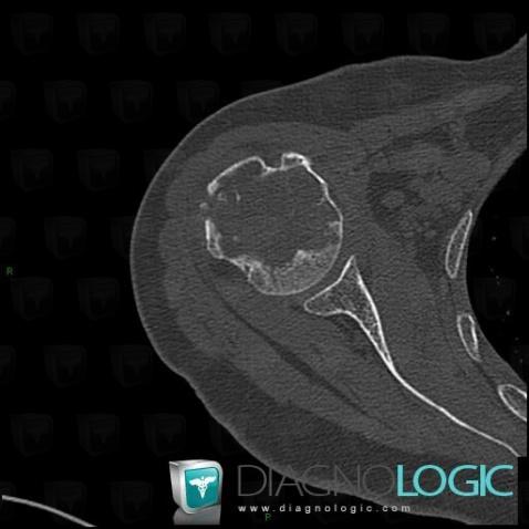 Chondrosarcoma, Humerus - Proximal part, CT