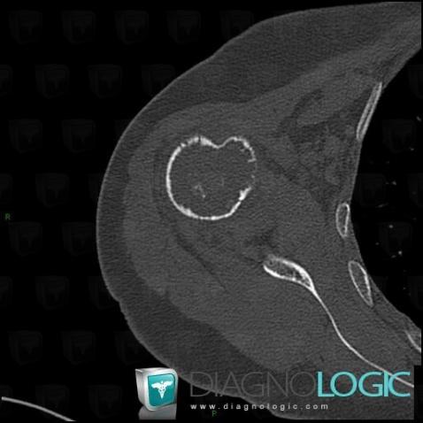 Chondrosarcoma, Humerus - Proximal part, CT