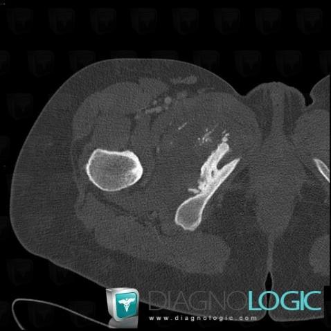 Chondrosarcoma, Ilium, CT