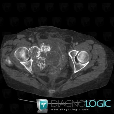 Chondrosarcoma, Ilium, CT