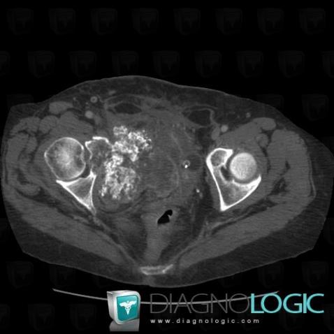 Chondrosarcoma, Ilium, Pelvic Muscles, CT