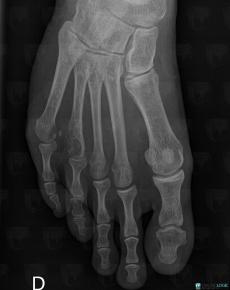 Chondrosarcoma, Metatarsal bones, X rays