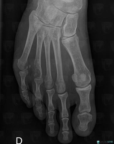 Chondrosarcoma, Metatarsal bones, X rays