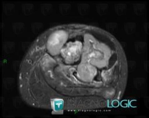 Chondrosarcoma, Muscles - Leg, MRI