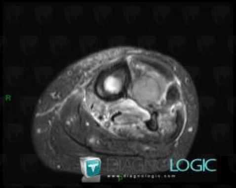 Chondrosarcoma, Muscles - Leg, Other soft tissues/nerves - Leg, MRI