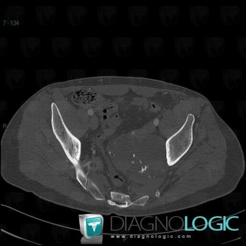 Chondrosarcoma, Other soft tissues/nerves - Pelvis, CT