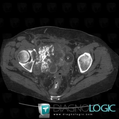 Chondrosarcoma, Other soft tissues/nerves - Pelvis, CT