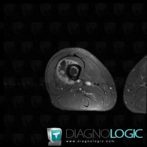 Chondrosarcoma, Other soft tissues/nerves - Thigh, Fibula - Mid part, MRI