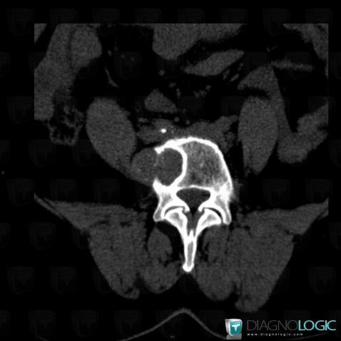 Chondrosarcoma, Paraspinal, CT