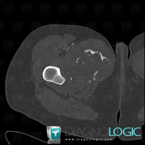 Chondrosarcoma, Pelvic Muscles, Other soft tissues/nerves - Pelvis, CT