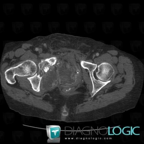 Chondrosarcoma, Pelvic Muscles, Other soft tissues/nerves - Pelvis, CT