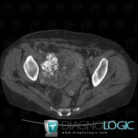 Chondrosarcoma, Pelvis / Perineum, CT