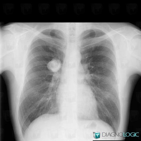 Chondrosarcoma, Pulmonary parenchyma, X rays