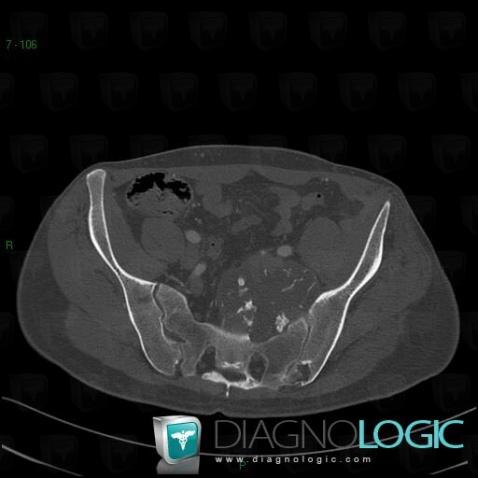 Chondrosarcoma, Sacrum / Coccyx, CT