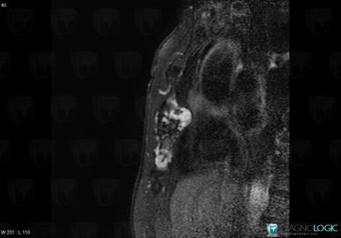 Chondrosarcoma, Sternum, MRI