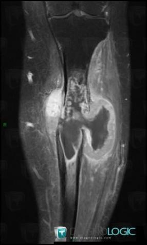 Chondrosarcoma, Tibia - Mid part, MRI