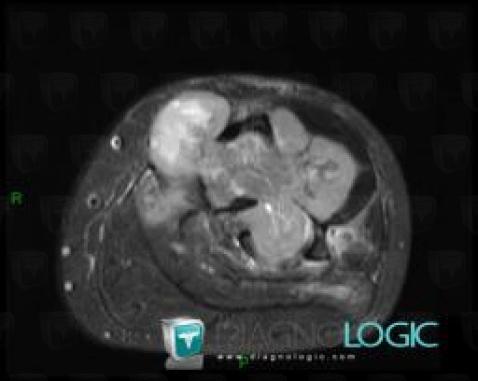 Chondrosarcoma, Tibia - Mid part, Other soft tissues/nerves - Leg, MRI