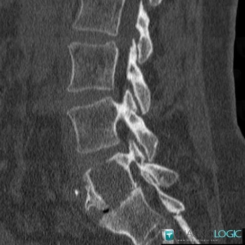 Chondrosarcoma, Vertebral body / Disk, CT