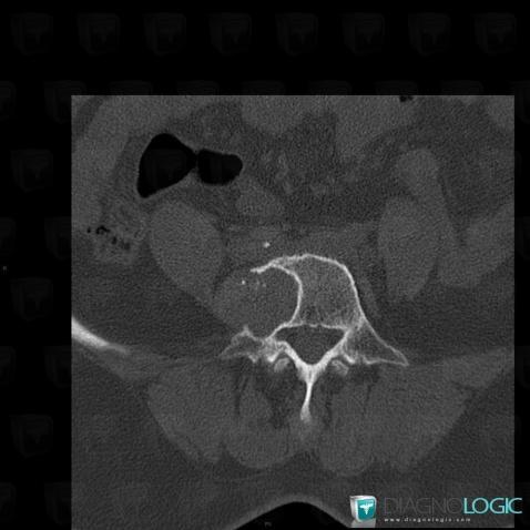 Chondrosarcoma, Vertebral body / Disk, CT