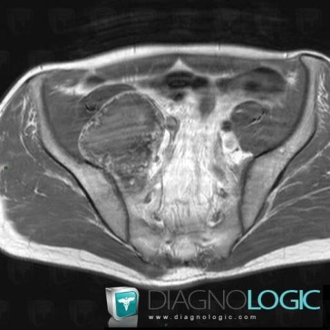 Chondrosarcome , Sacrum / Coccyx, IRM