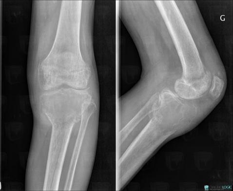 Chondrosarcome , Tibia -supérieur, Radio