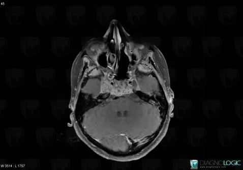 Chordoma, Infratentorial peri cerebral spaces, Posterior fossa, MRI