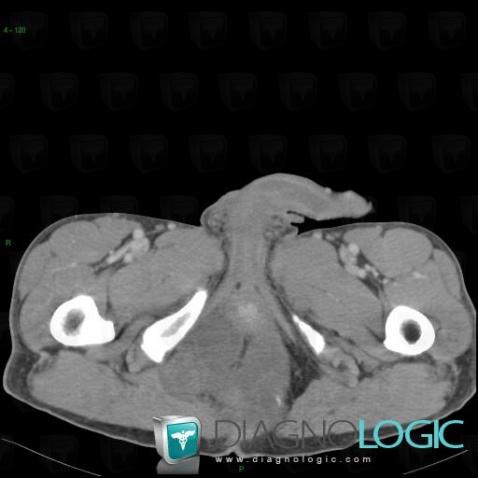 Chordoma, Paraspinal, CT