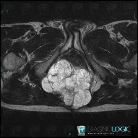 Chordoma, Paraspinal, MRI