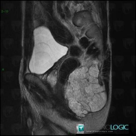 Chordoma, Pelvis / Perineum, MRI