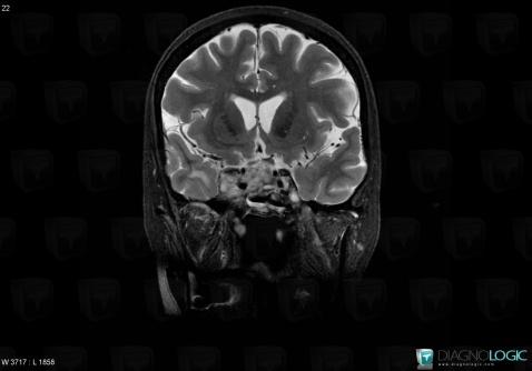 Chordoma, Pituitary gland and parasellar region, MRI