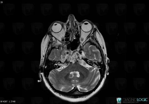 Chordoma, Posterior fossa, MRI