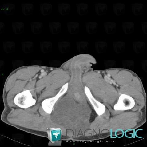 Chordoma, Sacrum / Coccyx, CT