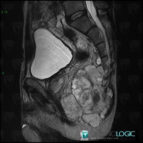 Chordoma, Sacrum / Coccyx, MRI