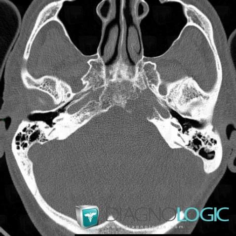 Radiology case : Chordoma (MRI ,CT) - Diagnologic