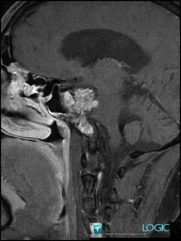 Chordoma, Sphenoid bone, MRI