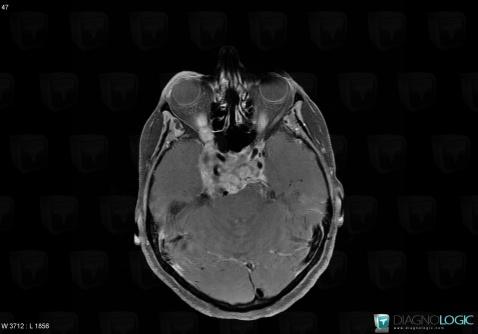 Chordoma, Sphenoid bone, MRI