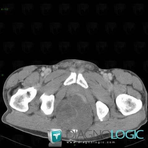 Chordome, Pelvis / Périnée, Scanner