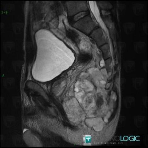 Chordome, Sacrum / Coccyx, IRM