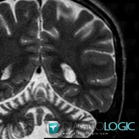 Choroid plexus cyst, Ventricles / Periventricular region, MRI